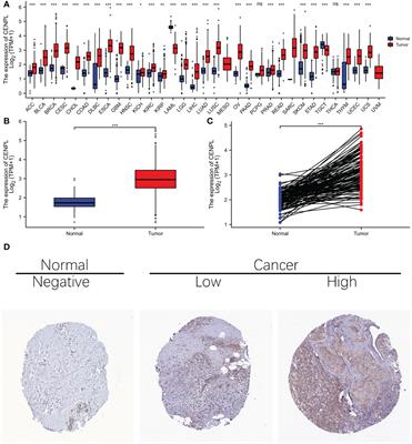 Highly expressed CENPL is correlated with breast cancer cell proliferation and immune infiltration